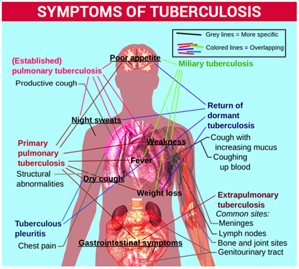 Symptoms of Tuberculosis Symptoms of Tuberculosis