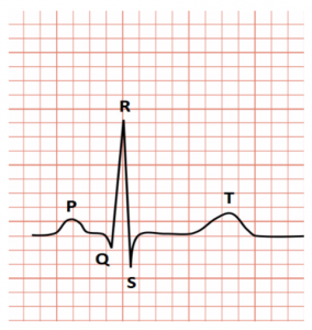 normal 12 lead ecg labeled