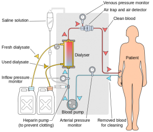 Dialysis and Artificial Kidney - Hemodialysis Dialysis and Artificial Kidney - Hemodialysis