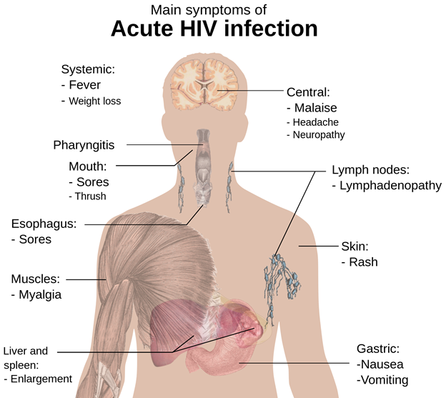 clinical presentation of aids