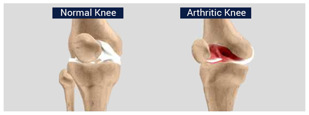 Arthritis: Symptoms, Causes, Types, Treatment & Prevention