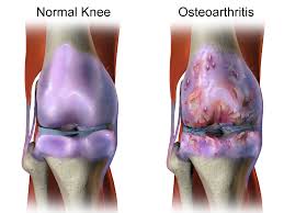 Arthritis: Causes, types, and treatments