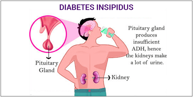 Image explaining the difference between Diabetes Mellitus and Diabetes Insipidus