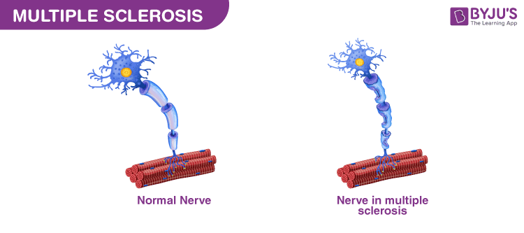 Multiple Sclerosis 1