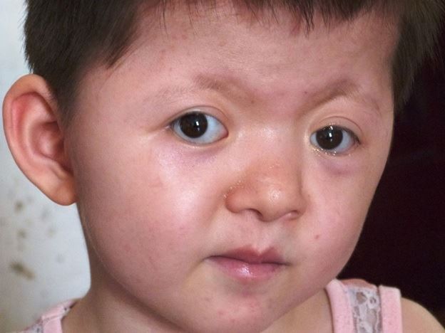 chromosomal abnormalities down syndrome