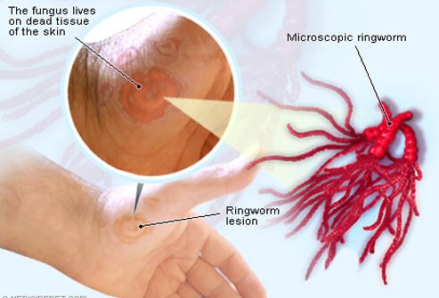 Ringworm Ringworm