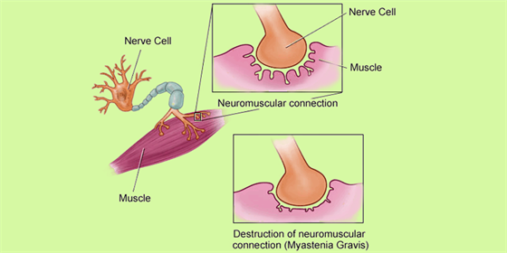 Myasthenia Gravis