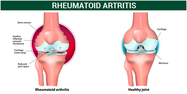 pathophysiology of rheumatoid arthritis diagram