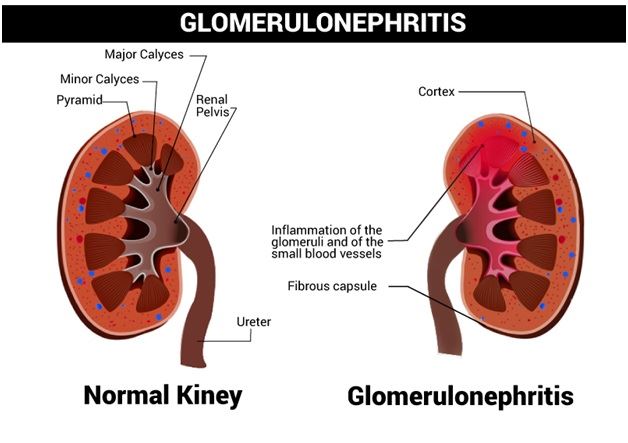 What Is Nephritis? - Types And Symptoms Of Nephritis