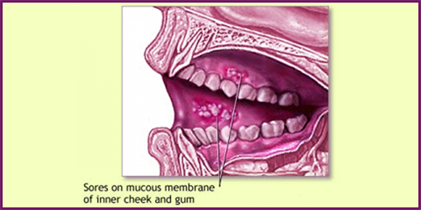 lip cancer from chewing