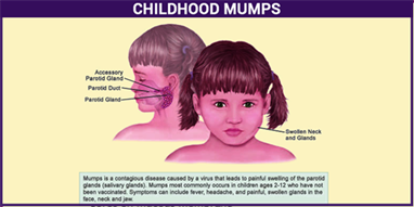 Mumps meaning