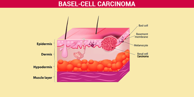 undifferential-carcinoma-in-young-girl
