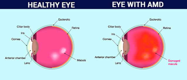 Age-Related Macular Degeneration Age-Related Macular Degeneration