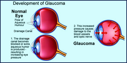 Glaucoma Glaucoma