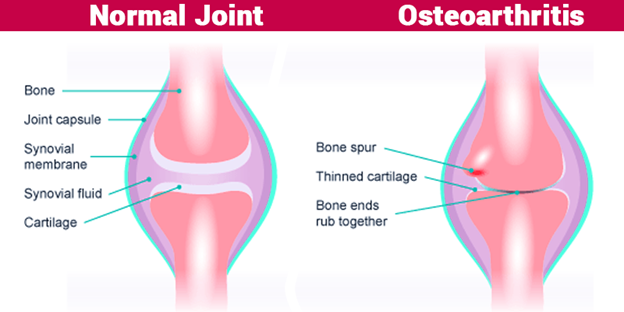 Osteoarthritis Osteoarthritis