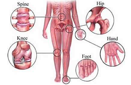 Osteoarthritis Types Osteoarthritis Types