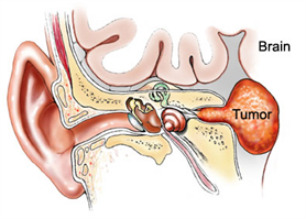 Acoustic Neuroma Acoustic Neuroma