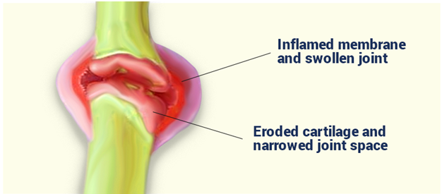 Polyarthritis Polyarthritis