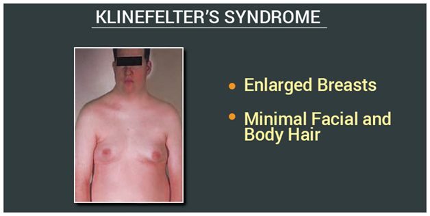 Klinefelter Syndrome Causes Symptoms And Treatment 5896