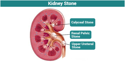 Kidney Stone