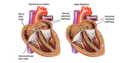 Atrial fibrillation Atrial fibrillation