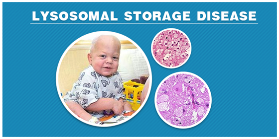 Lysosomal Storage Disease -Types, Symptoms, Causes and its Treatment