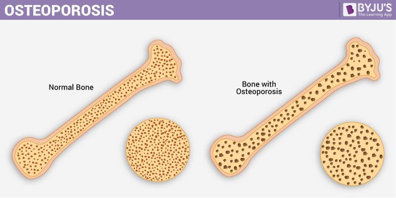 Osteoporosis - Causes, Signs and its Symptoms