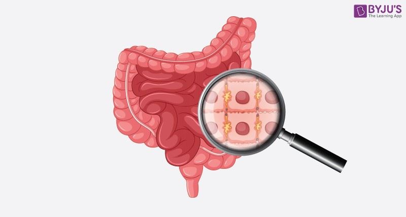 Crohn Disease