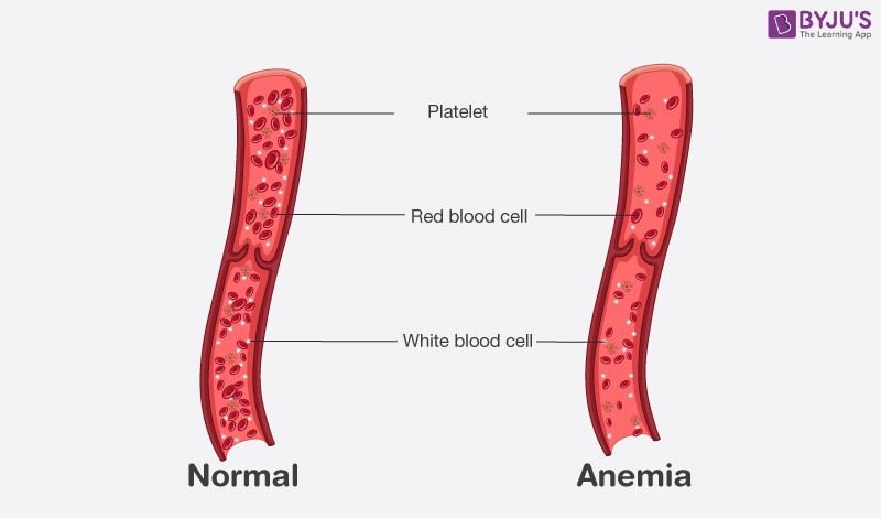 Pernicious Anemia