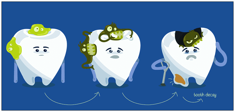 Tooth Decay