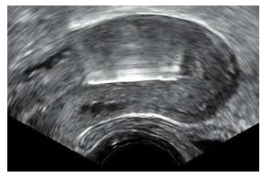 Application of Ultrasound