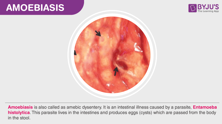 amoebiasis patient