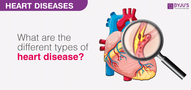 4 Types Of Cardiovascular Disease