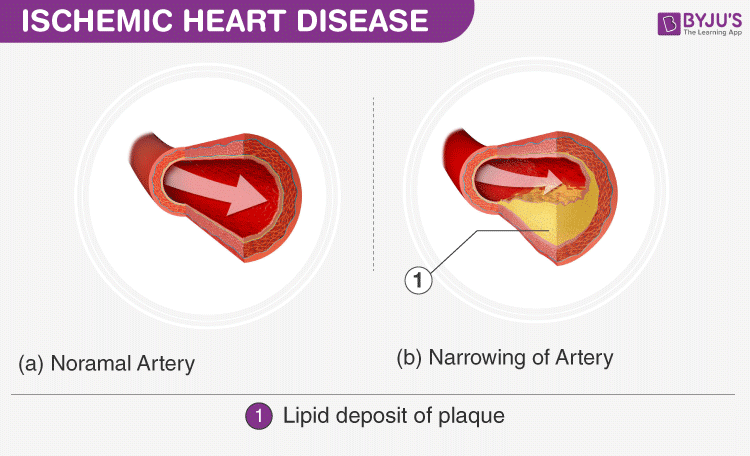 Heart Diseases - Types of Heart Diseases, Causes and Treatments