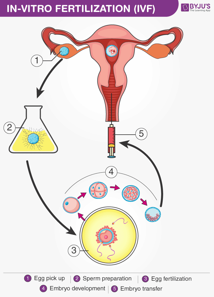 In Vitro Fertilization