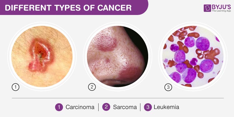 Types of Cancer