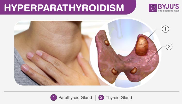 Can Hyperparathyroidism Cause Stomach Problems