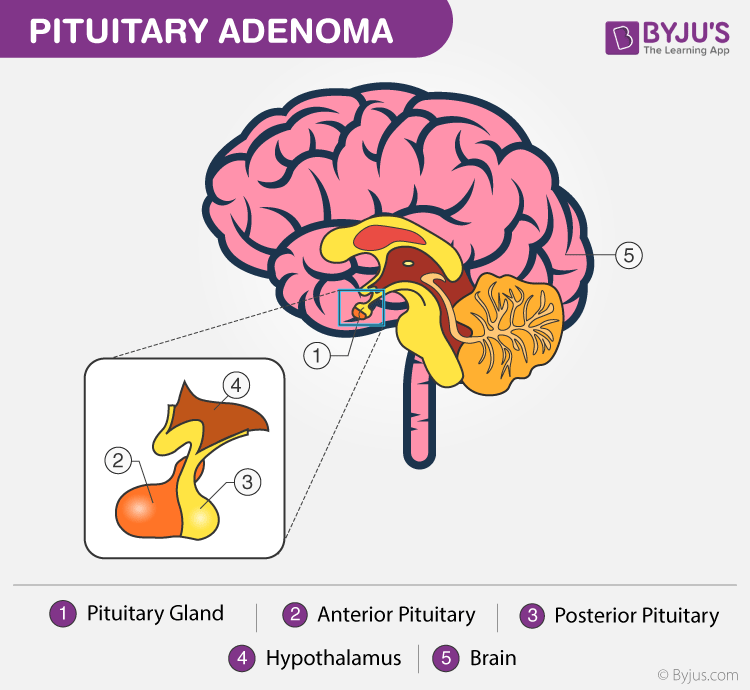 Pituitary tumors and dizziness