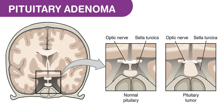 Pituitary Adenoma