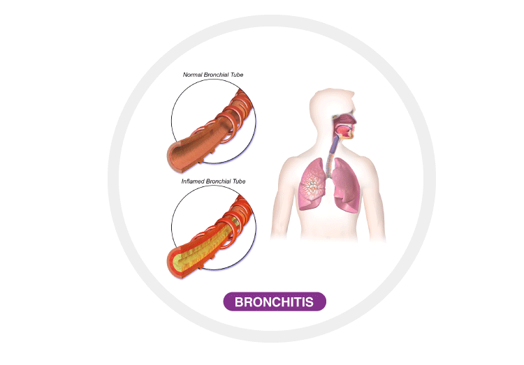 Lung Diseases – Types, Causes, and their Symptoms