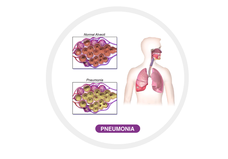 Pneumonia