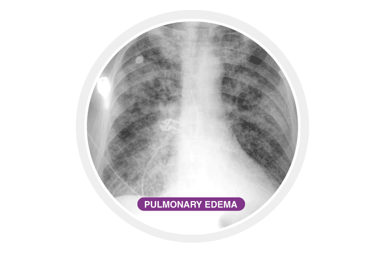 Pulmonary edema