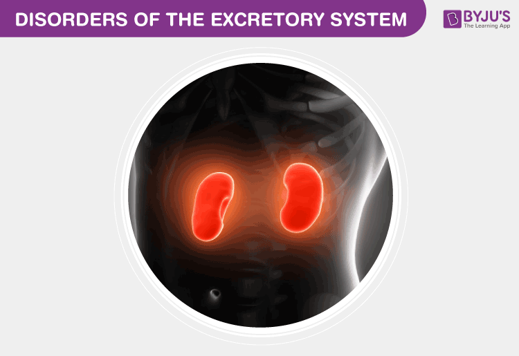 Disorders Of The Excretory System