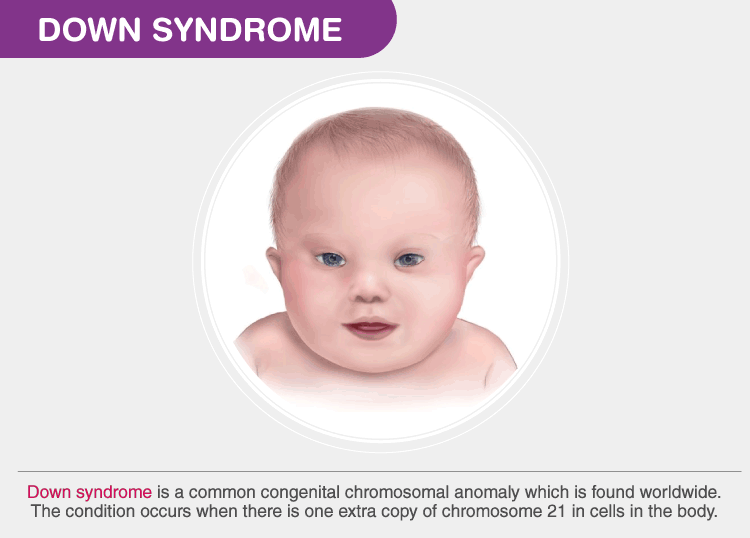 Cognitive characteristics discount of down syndrome