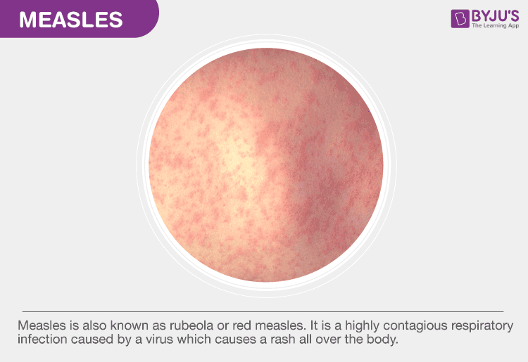 measles causes