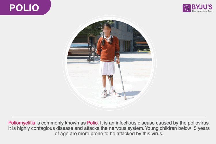 Polio - Causes, Types, Sign and Symptoms of Poliomyelitis