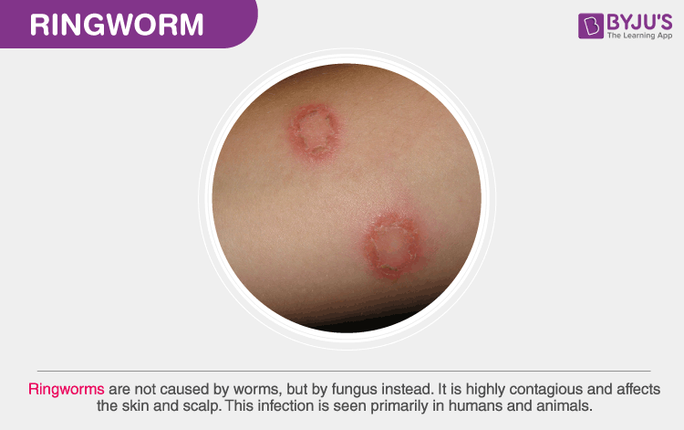 ringworm stages