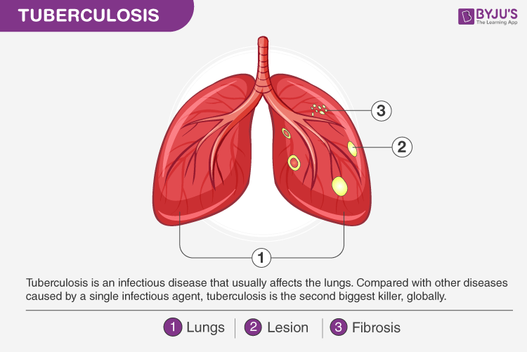 Tuberculosis Tb Definition Causes Diagnosis Treatment