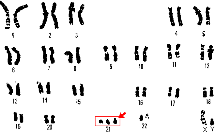 Down's syndrome karyotype