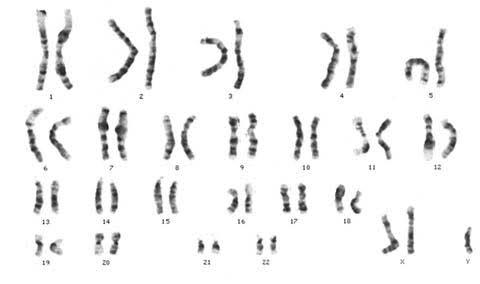 Klinefelter's syndrome karyotype